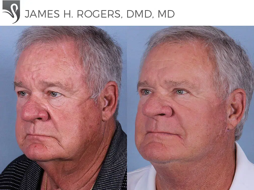 Before and After Image: Face Lift Case #50352 - left-front-oblique