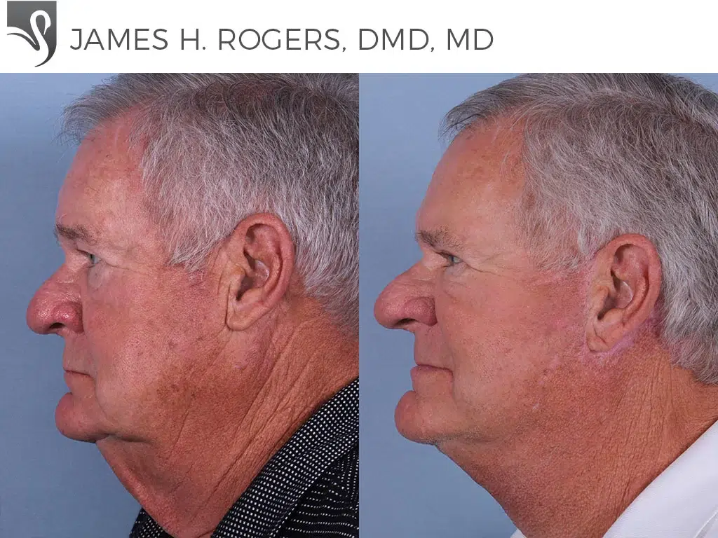 Before and After Image: Face Lift Case #50352 - left-side