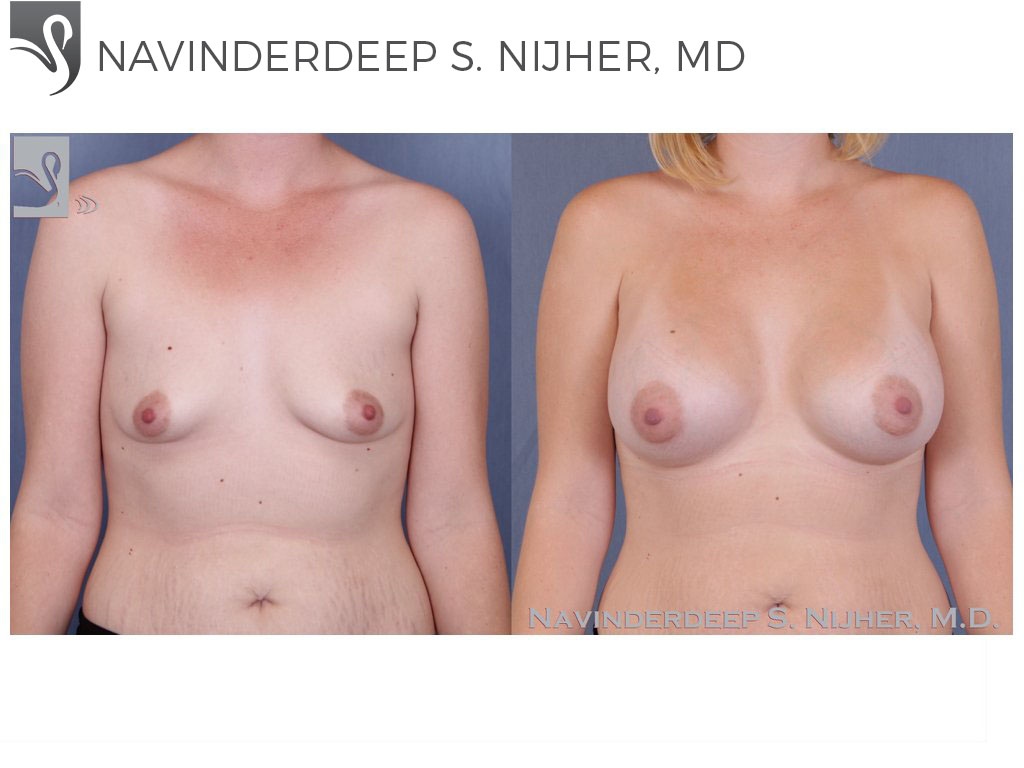 Before and After Image: Breast Augmentation Case #50357 - front