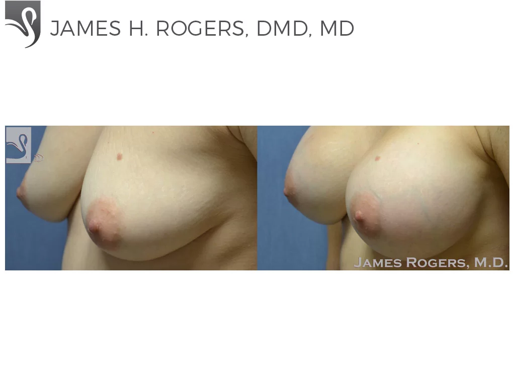 Before and After Image: Breast Augmentation Case #50465 - left-front-oblique