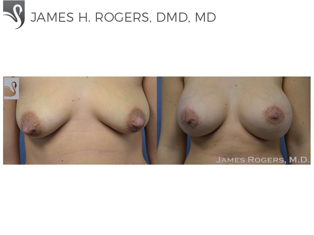 Before and After Image: Breast Augmentation Case #50609 - front