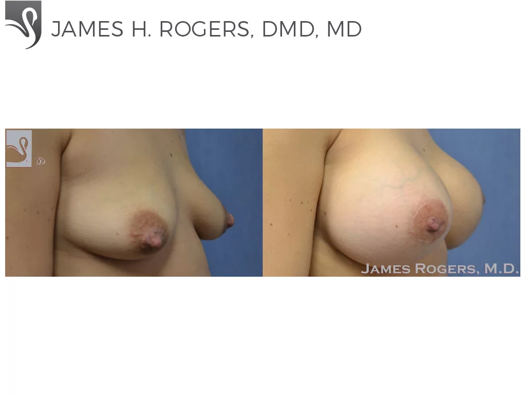 Before and After Image: Breast Augmentation Case #50609 - right-front-oblique