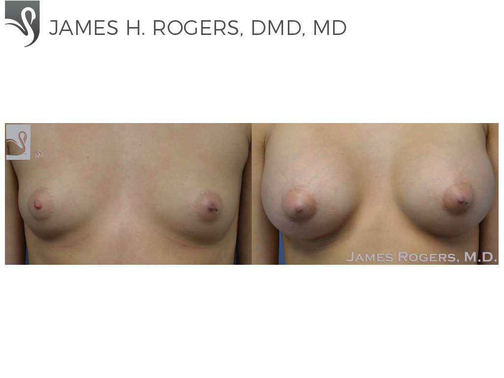 Before and After Image: Breast Augmentation Case #50636 - front