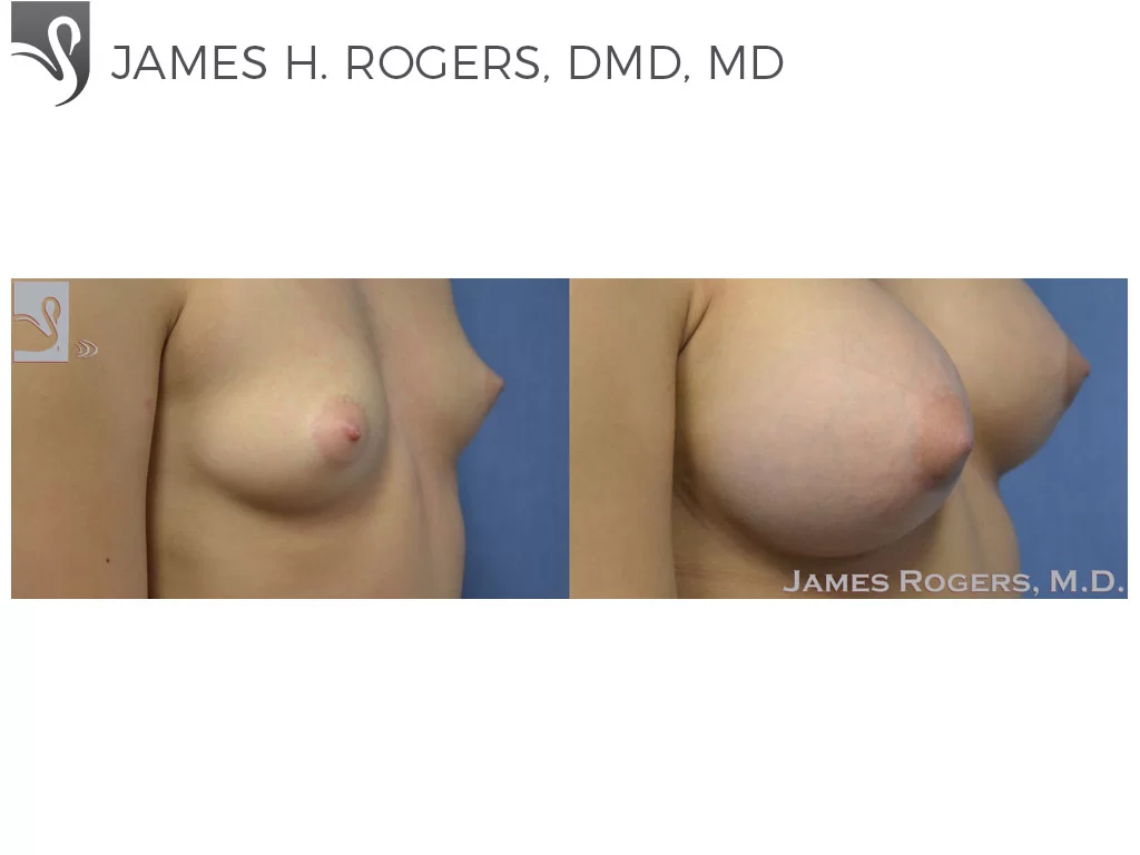 Before and After Image: Breast Augmentation Case #50636 - right-front-oblique