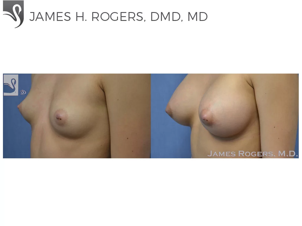 Before and After Image: Breast Augmentation Case #50636 - left-front-oblique