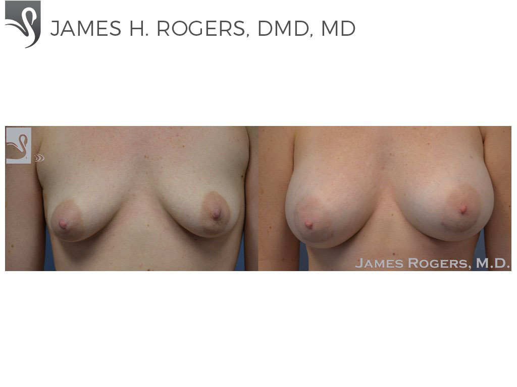 Before and After Image: Breast Augmentation Case #50721 - front
