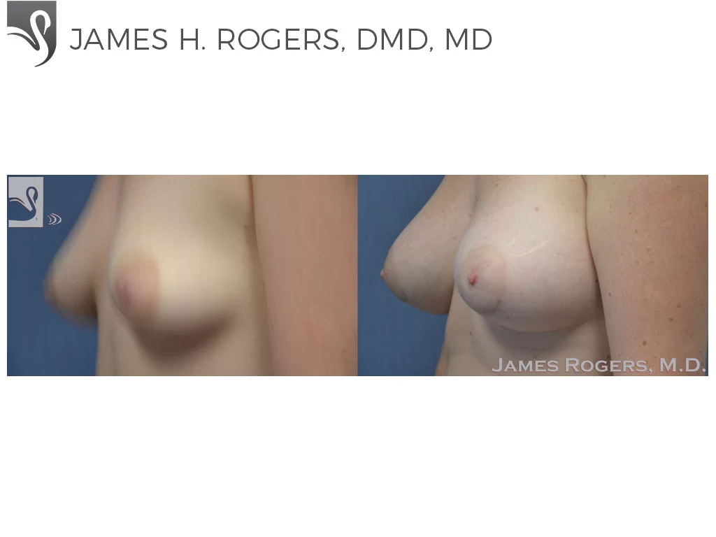 Before and After Image: Breast Augmentation Case #50721 - left-front-oblique