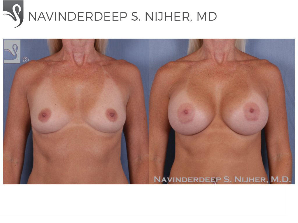 Before and After Image: Breast Augmentation Case #50803 - front