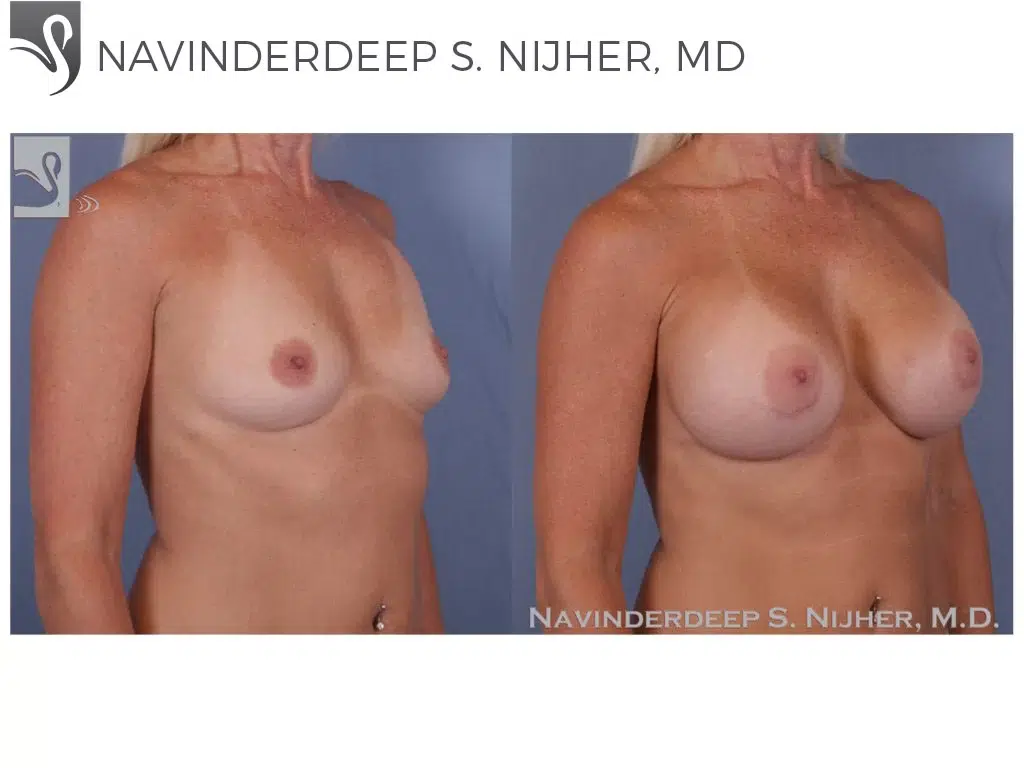 Before and After Image: Breast Augmentation Case #50803 - right-front-oblique