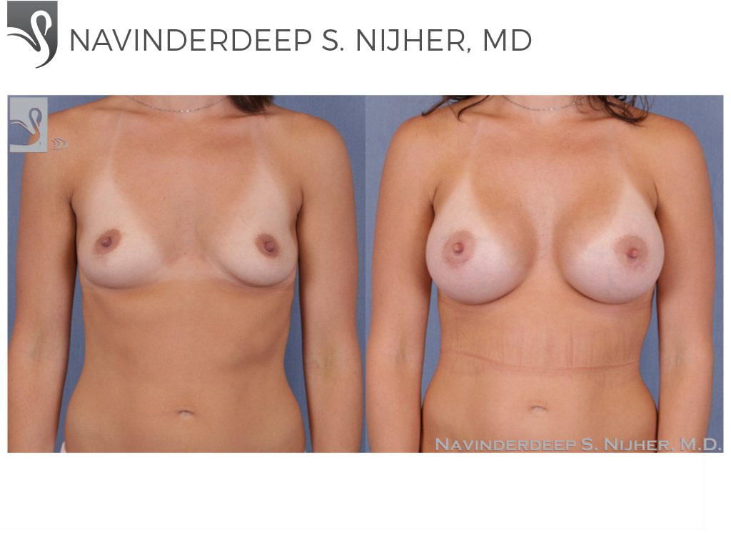 Before and After Image: Breast Augmentation Case #50854 - front