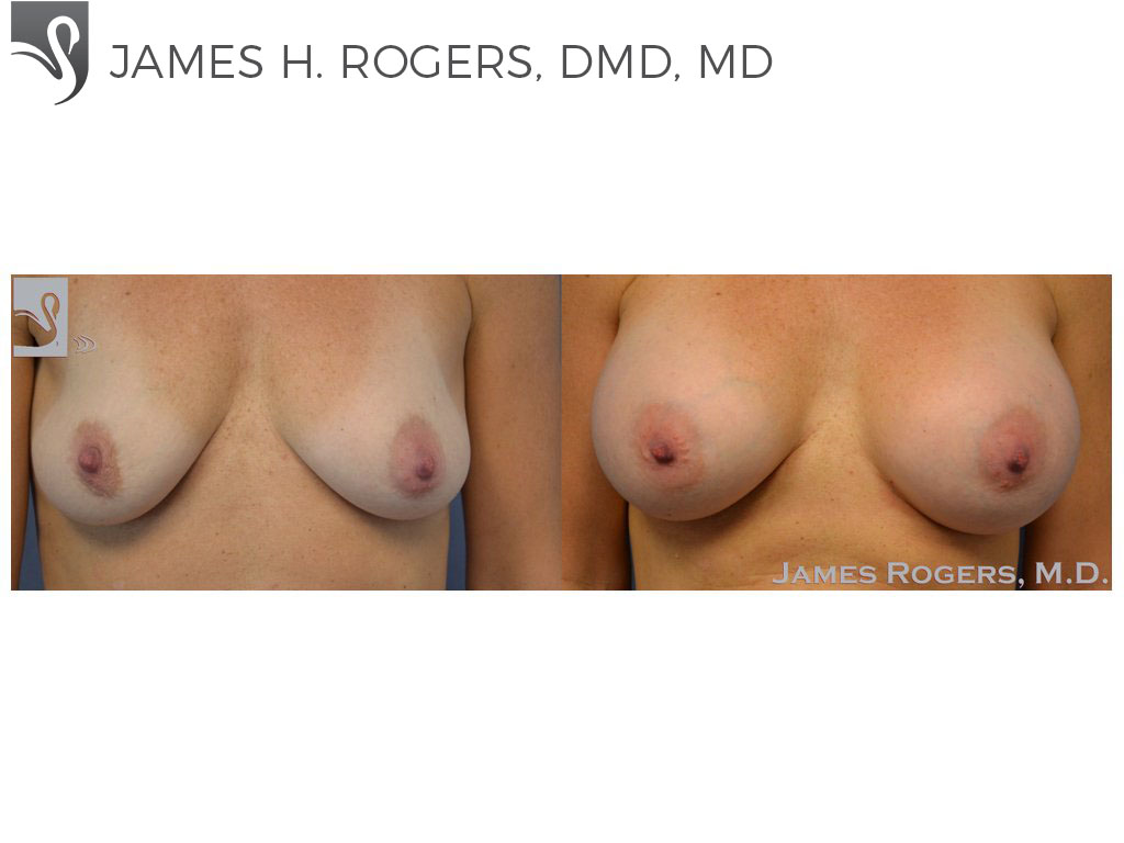 Before and After Image: Breast Augmentation Case #51001 - front