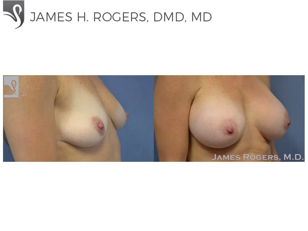 Before and After Image: Breast Augmentation Case #51001 - right-front-oblique