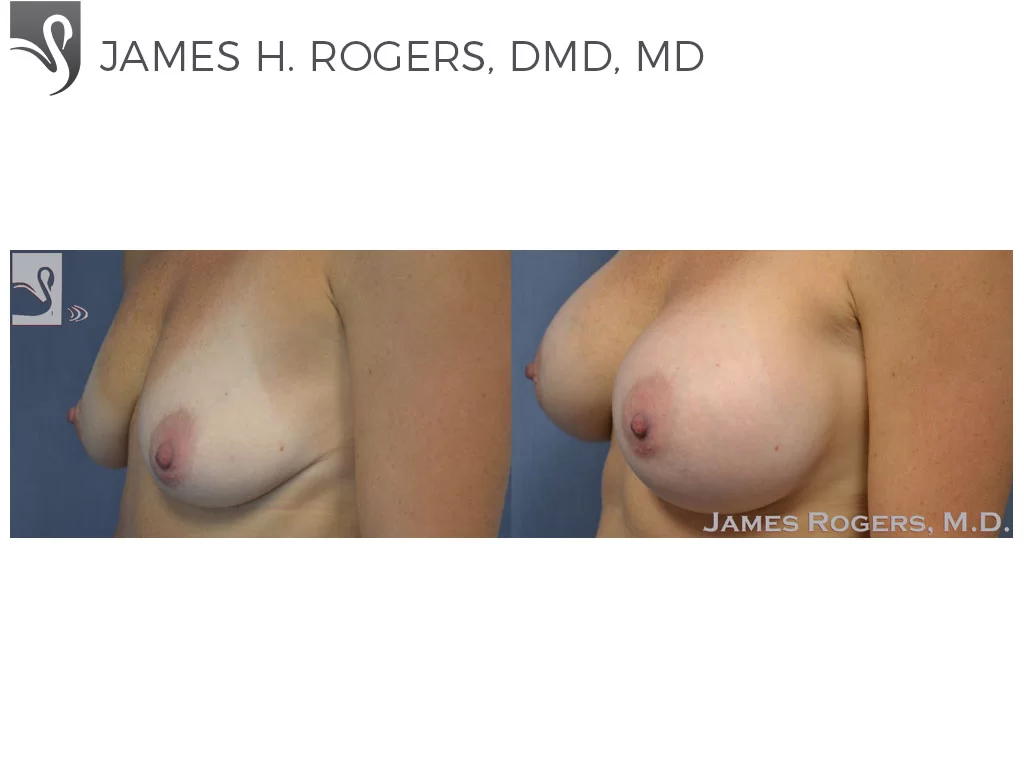 Before and After Image: Breast Augmentation Case #51001 - left-front-oblique