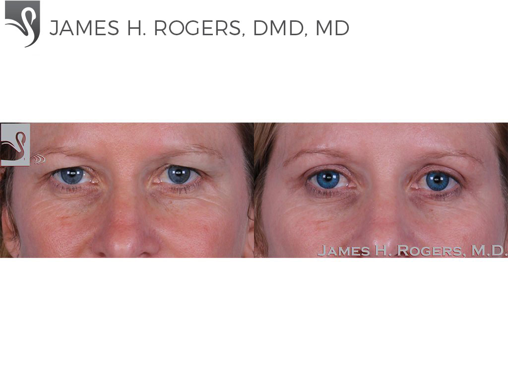 Before and After Image: Eyelid Surgery Case #51001 - front