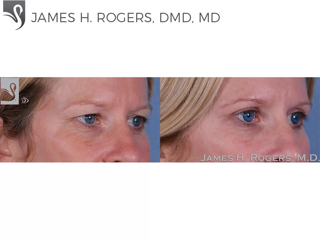 Before and After Image: Eyelid Surgery Case #51001 - right-front-oblique