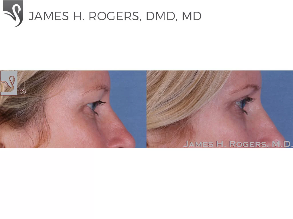 Before and After Image: Eyelid Surgery Case #51001 - right-side