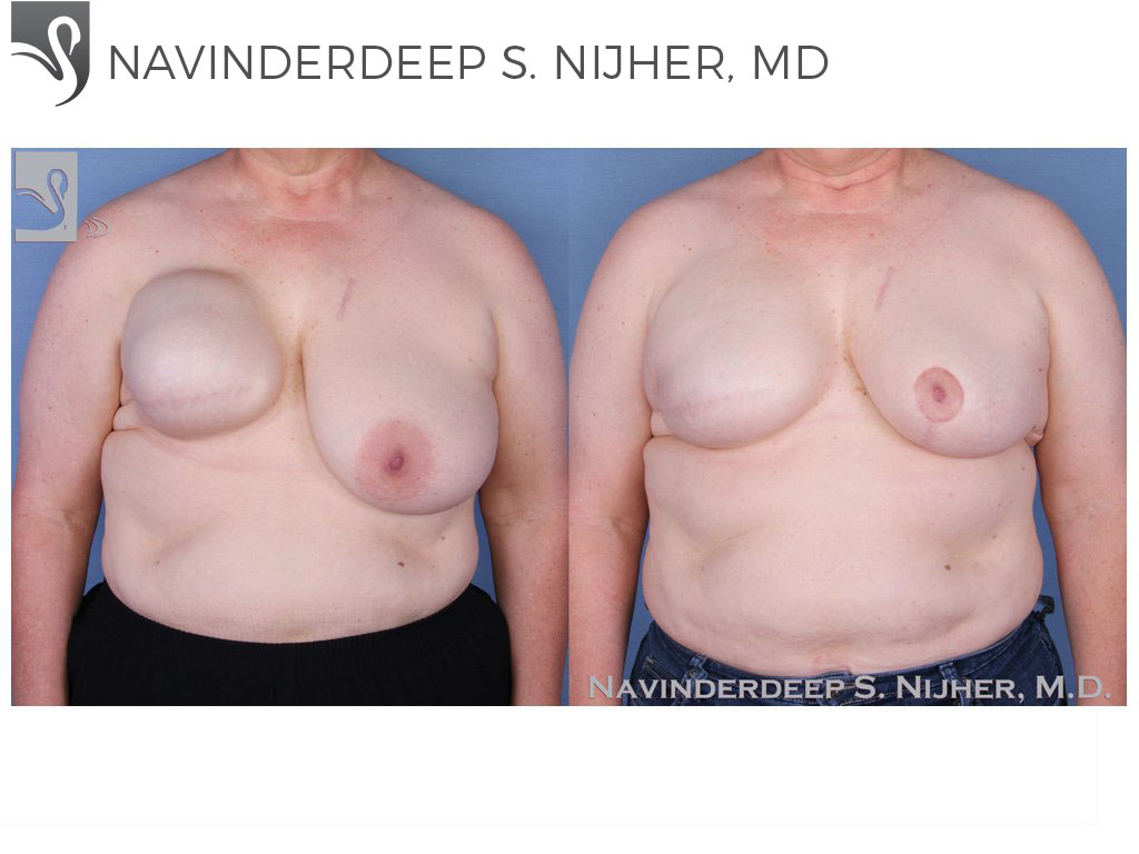 Before and After Image: Breast Reconstruction Case #51281 - front