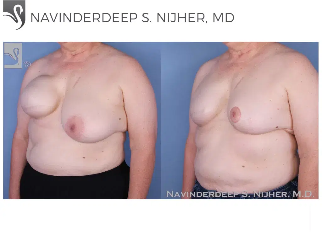 Before and After Image: Breast Reconstruction Case #51281 - left-front-oblique