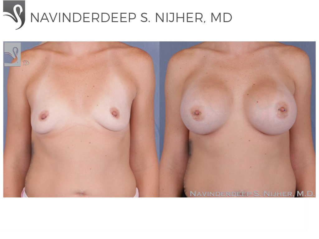 Before and After Image: Breast Augmentation Case #51310 - front