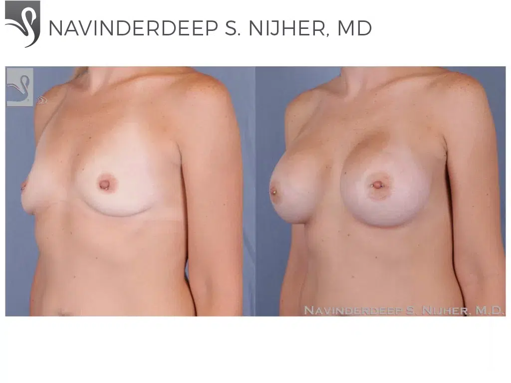 Before and After Image: Breast Augmentation Case #51310 - left-front-oblique