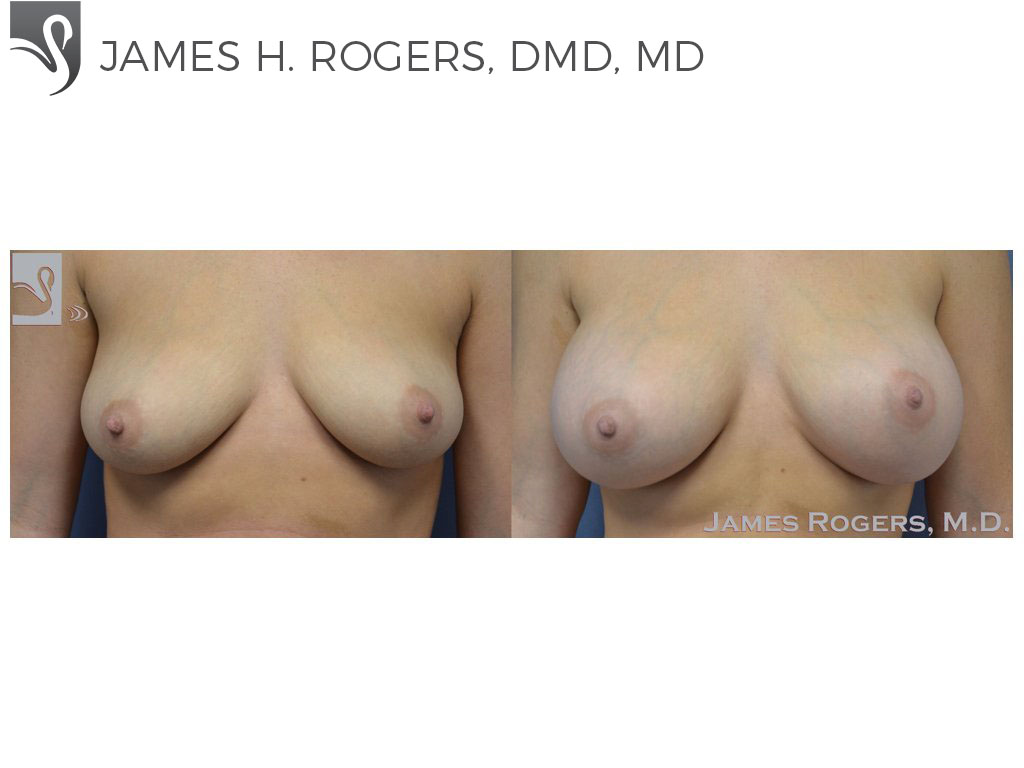 Before and After Image: Breast Augmentation Case #51333 - front