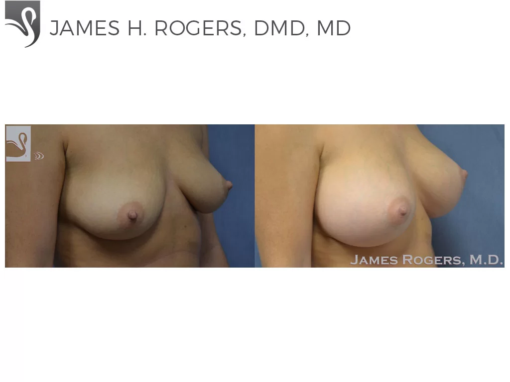 Before and After Image: Breast Augmentation Case #51333 - right-front-oblique