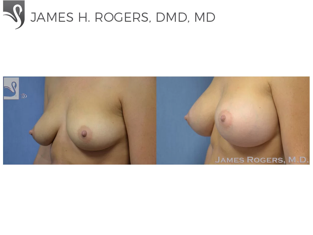 Before and After Image: Breast Augmentation Case #51333 - left-front-oblique