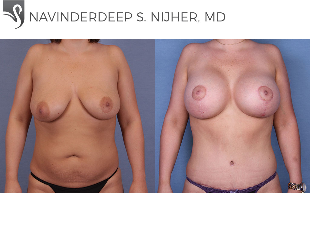 Before and After Image: Breast Lift (Mastopexy) Case #51344 - front