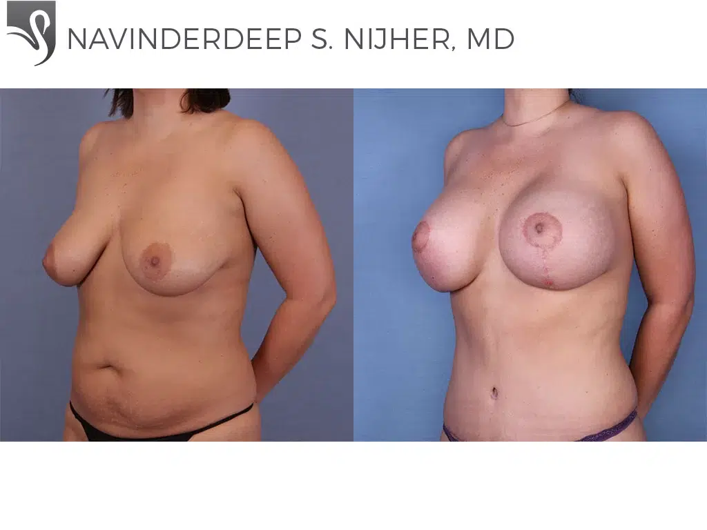 Before and After Image: Breast Lift (Mastopexy) Case #51344 - left-front-oblique
