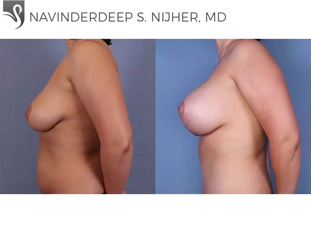 Before and After Image: Breast Lift (Mastopexy) Case #51344 - left-side