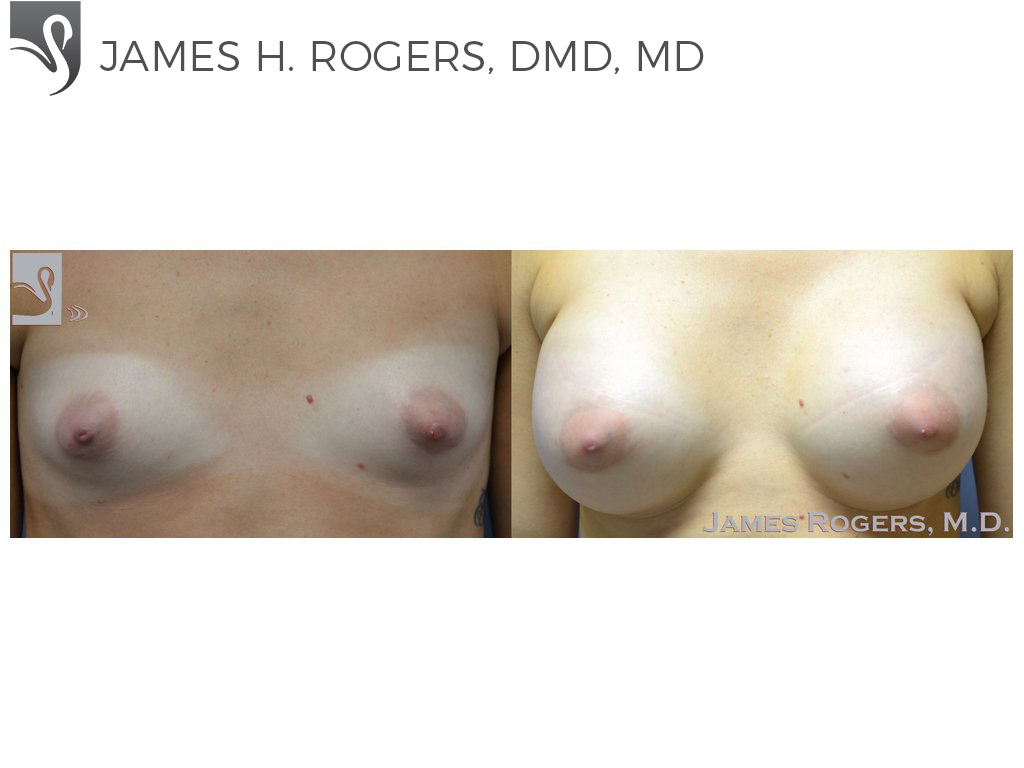 Before and After Image: Breast Augmentation Case #51607 - front