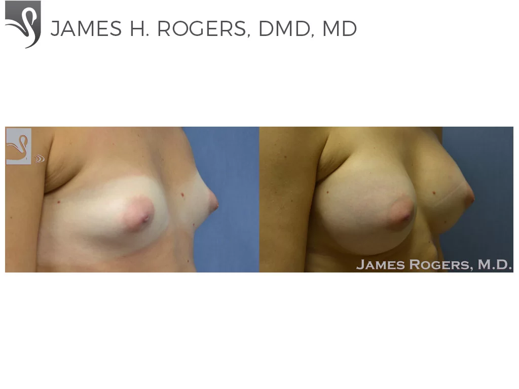 Before and After Image: Breast Augmentation Case #51607 - right-front-oblique