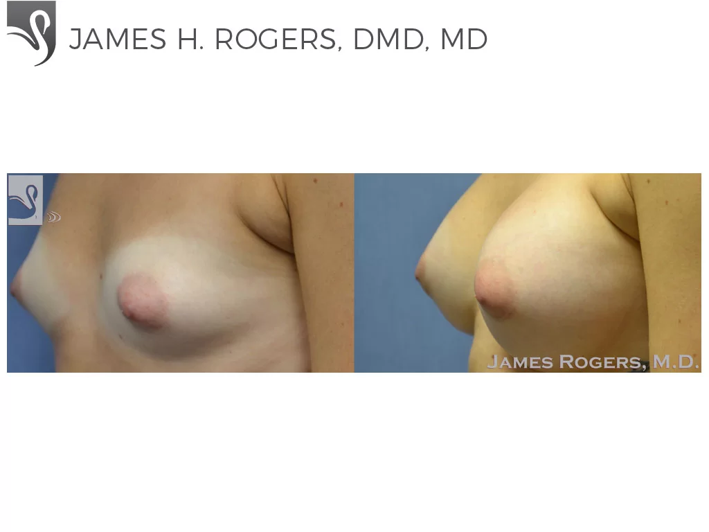 Before and After Image: Breast Augmentation Case #51607 - left-front-oblique