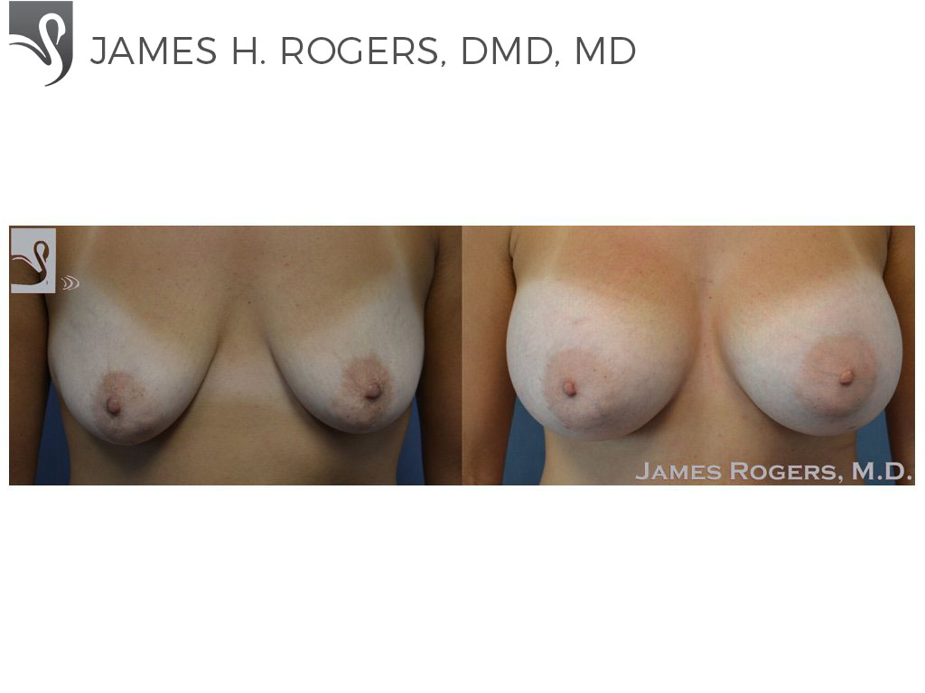 Before and After Image: Breast Augmentation Case #51706 - front
