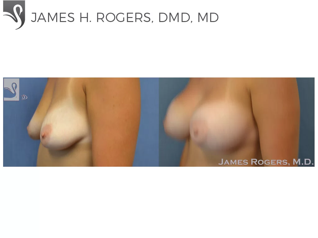 Before and After Image: Breast Augmentation Case #51706 - left-front-oblique