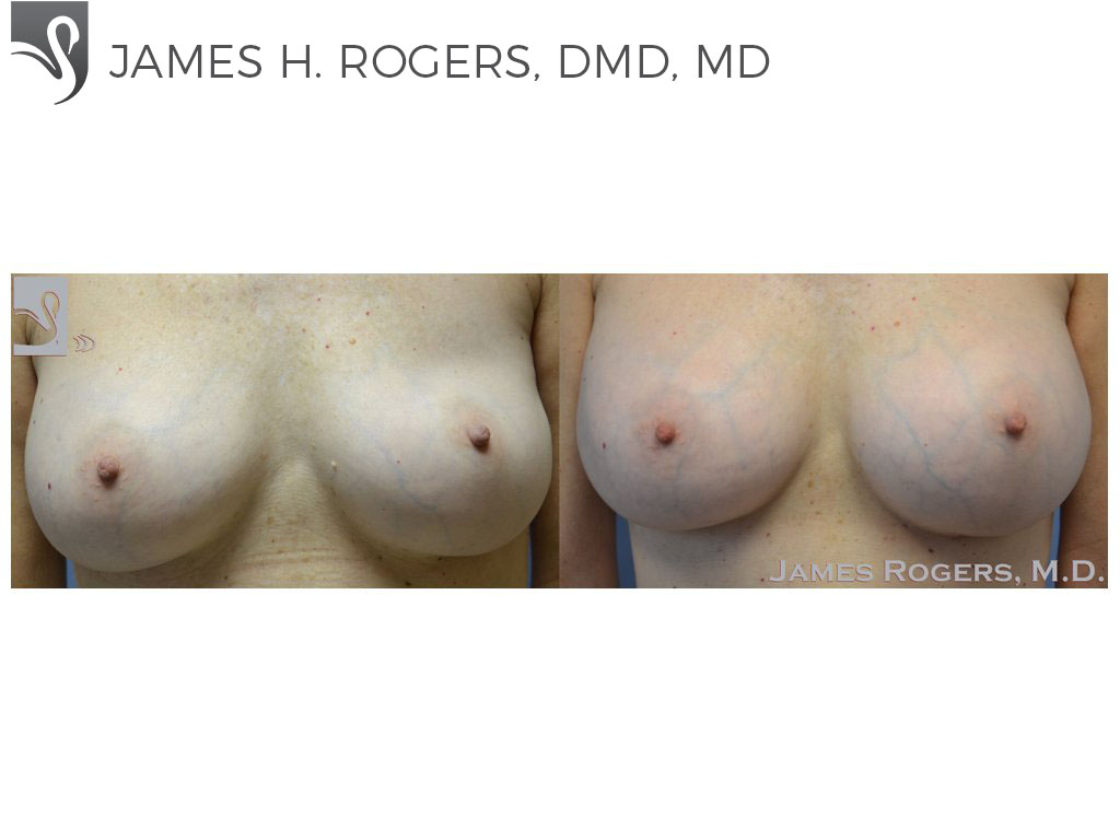Before and After Image: Breast Revisions Case #51781 - front