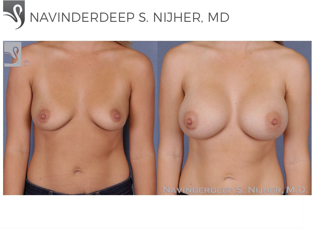 Before and After Image: Breast Augmentation Case #51922 - front