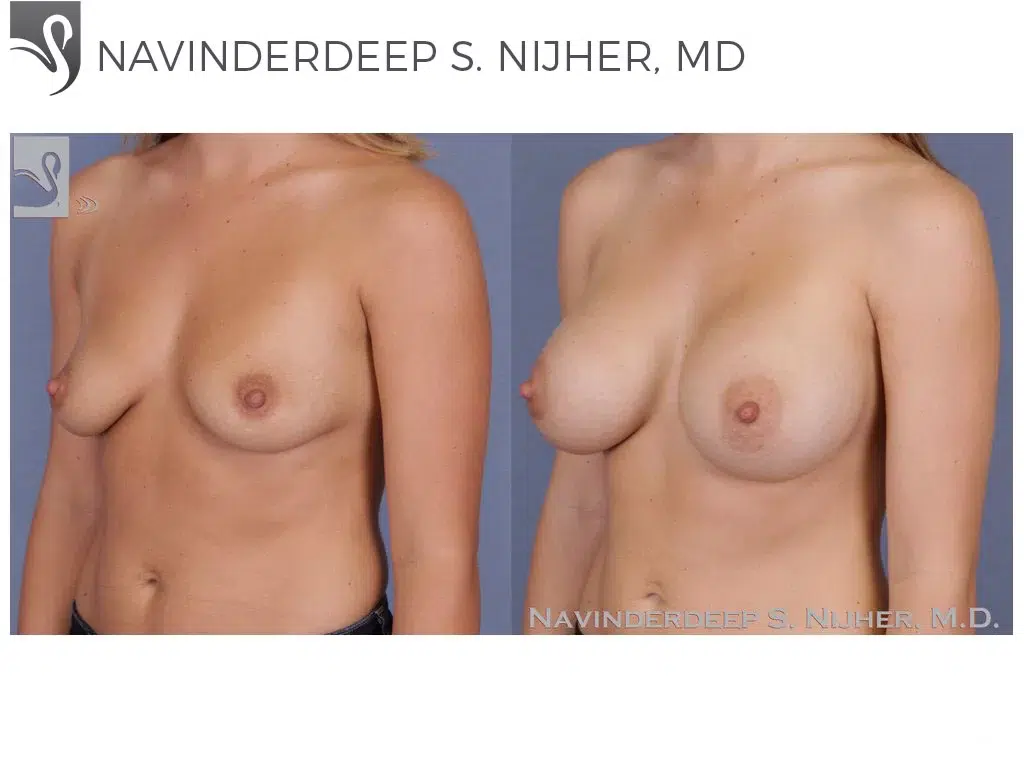 Before and After Image: Breast Augmentation Case #51922 - left-front-oblique