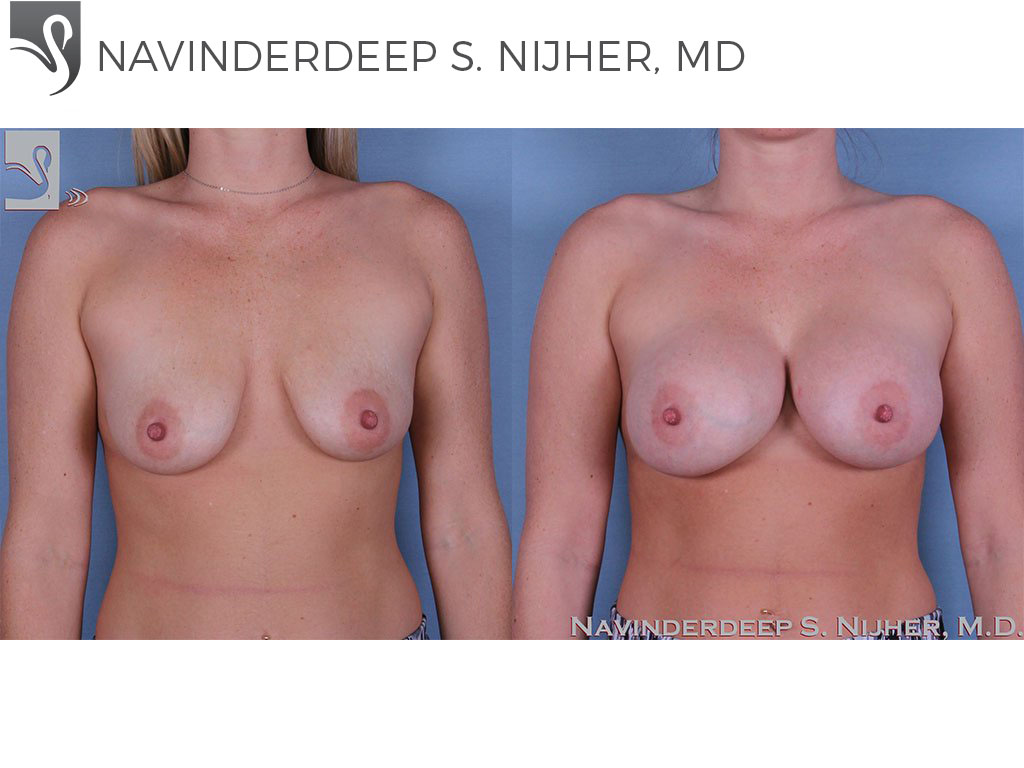 Before and After Image: Breast Augmentation Case #51944 - front