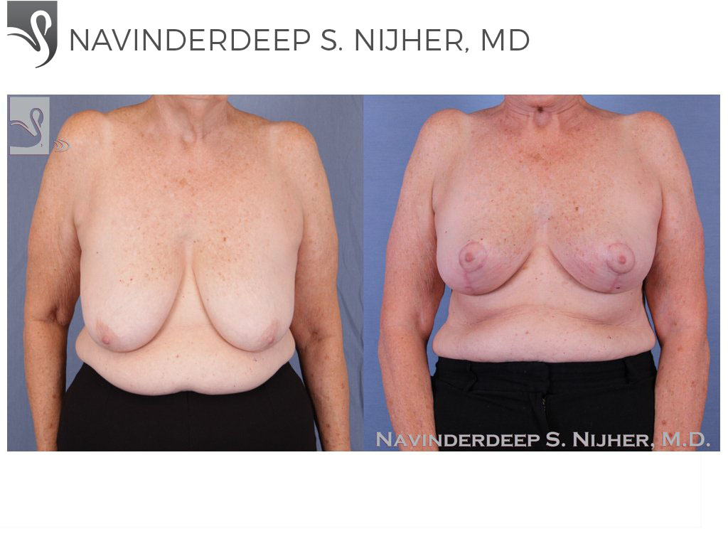 Before and After Image: Female Breast Reduction Case #51961 - front
