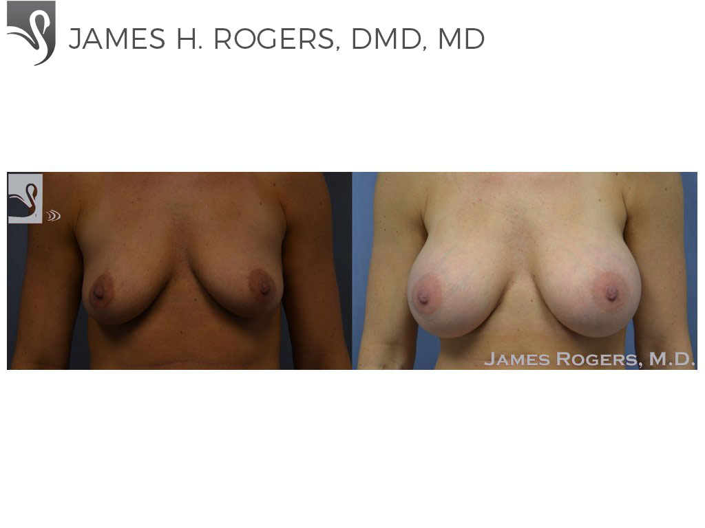 Before and After Image: Breast Augmentation Case #51975 - front