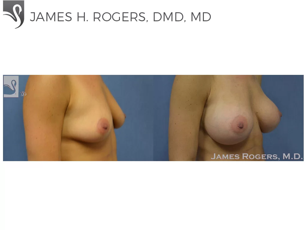 Before and After Image: Breast Augmentation Case #51975 - right-front-oblique