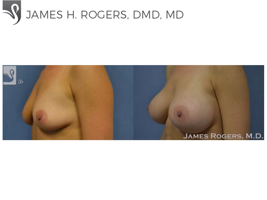 Before and After Image: Breast Augmentation Case #51975 - left-front-oblique