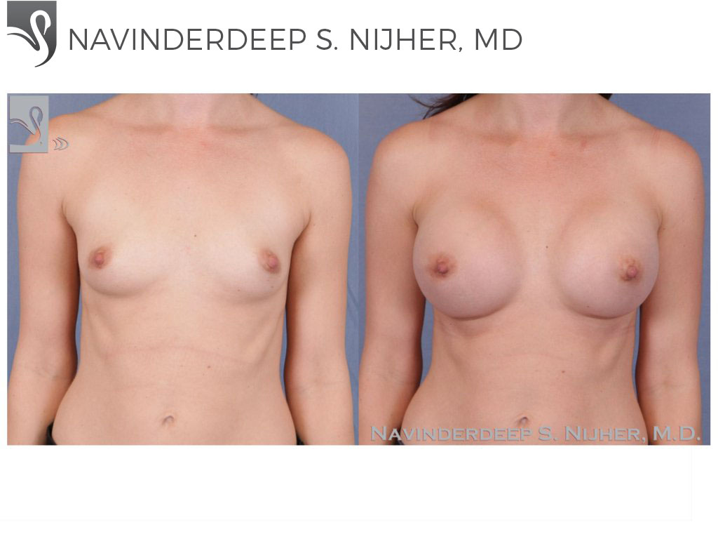 Before and After Image: Breast Augmentation Case #52110 - front