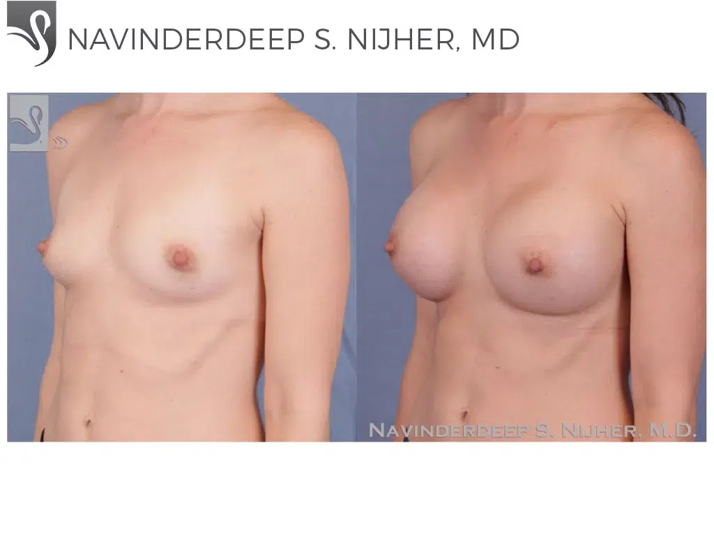 Before and After Image: Breast Augmentation Case #52110 - left-front-oblique