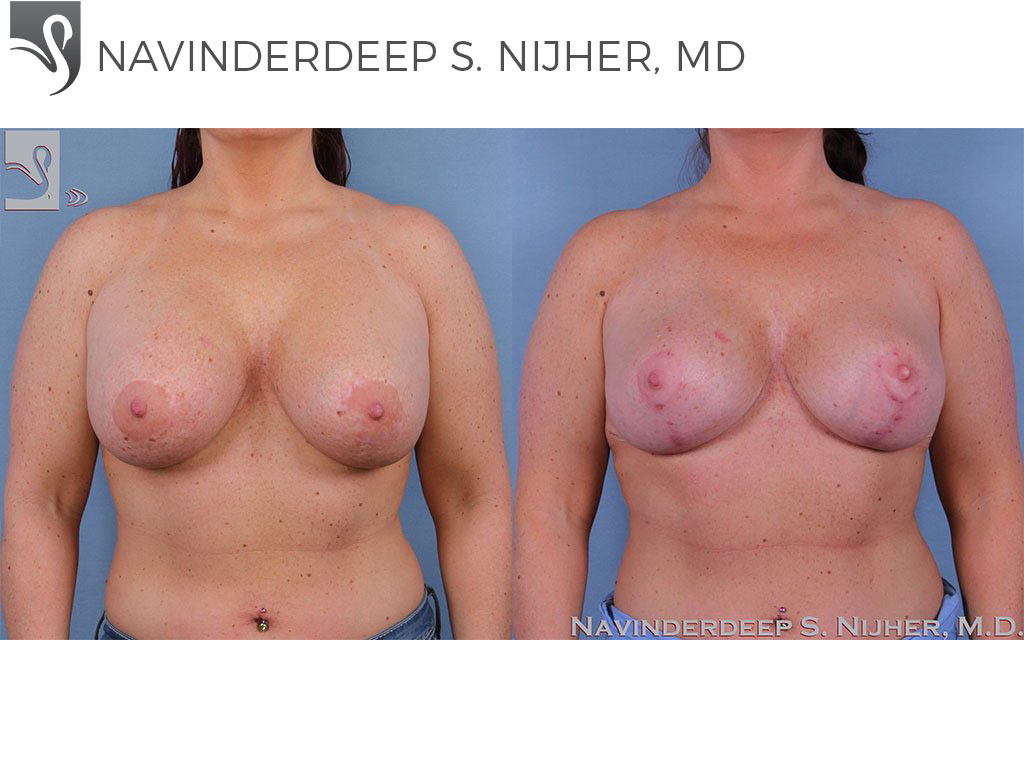 Before and After Image: Breast Revisions Case #52180 - front