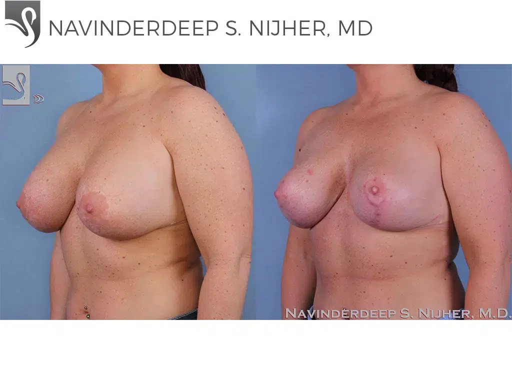 Before and After Image: Breast Revisions Case #52180 - left-front-oblique