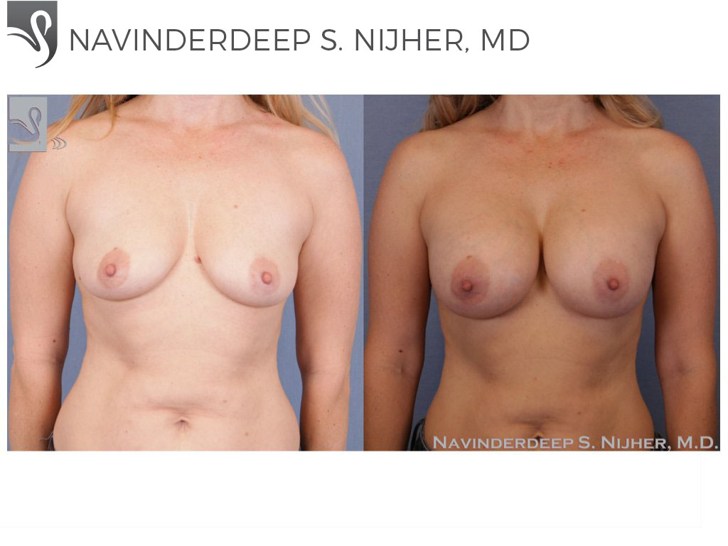 Before and After Image: Breast Augmentation Case #52221 - front