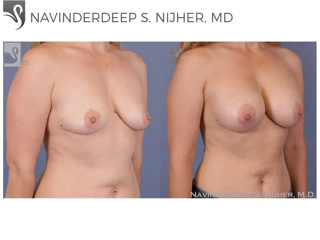Before and After Image: Breast Augmentation Case #52221 - right-front-oblique