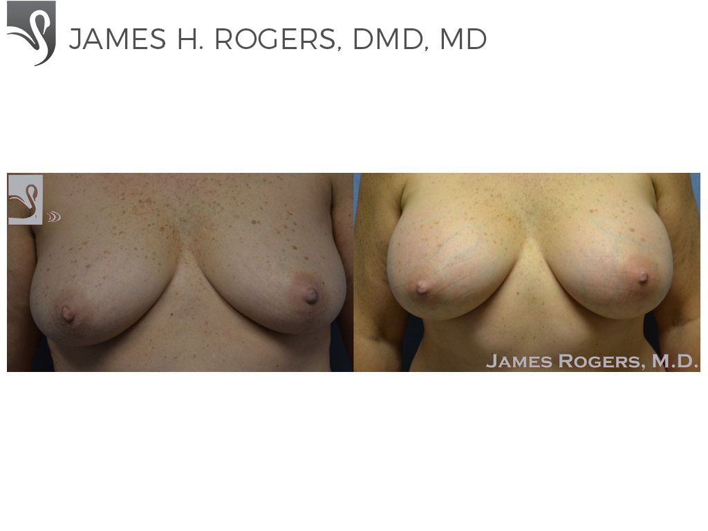 Before and After Image: Breast Augmentation Case #52304 - front